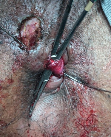 Cirurgia de fistula anal leva ponto