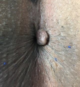 Plicoma anal sangra